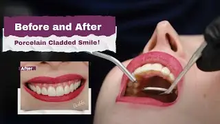 Porcelain Veneers Will Upgrade Your Smiling Game