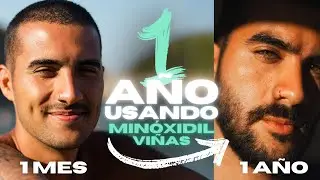 Cómo hacer CRECER tu BARBA | 1 AÑO USANDO MINOXIDIL VIÑAS