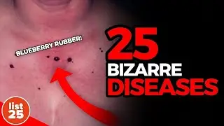 25 BIZARRE DISEASES Science Can't solve