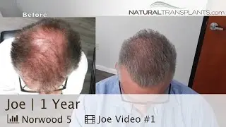 Hair Transplant After 1 Year For Norwood 5 Patient | Dr. Huebner (Joe)