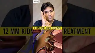 12 mm Kidney stone treatment | RIRS | How kidney stones are removed #rirs