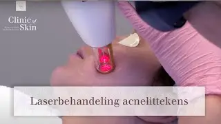Laserbehandeling acnelittekens