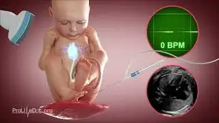 This Advanced Technology Is Changing the Future of Childbirth