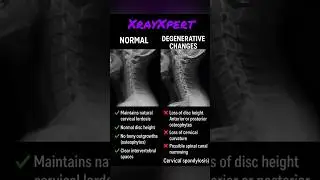 🦴 Cervical Spine &ndash; Normal vs Degenerative Changes🔍 X-ray Comparison #medicalimaging #xrayxpert #cxr