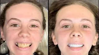 Rachel&rsquo;s Jaw Dropping Smile Reveal!!❤️🥲🥲