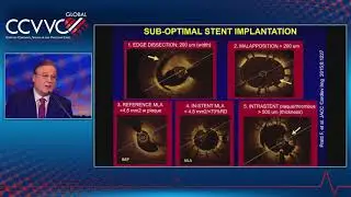 Coronary Physiology and Imaging: OCT-Guided PCI May Be Better