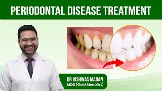 Periodontal Disease Treatment | GUM Disease | What is the Best Treatment for Periodontal Disease ?