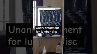 unani treatment for disc #unani #bums #disc