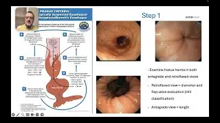 Why I Ignore the AGA Guidelines for Barrett&rsquo;s Biopsies