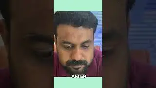 #haircare #baldnesssolution #hairtransformation #advancedhairtreatment  #hair #affordablehaircare