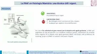 La PAAF en Patologia Mam&agrave;ria: una t&egrave;cnica &uacute;til i vigent.