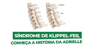 S&iacute;ndrome de Klippel-Feil: a hist&oacute;ria da paciente Adrielle