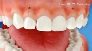 Why Periodontal Surgery?