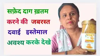सफेद दाग का सफल इलाज #home treatment for white spots#vitiligo #
