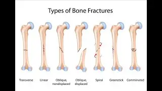 Fractures management #fracture #fractures #fracturerecovery