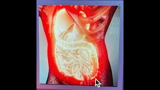 Do you have 'Metaflammation'?