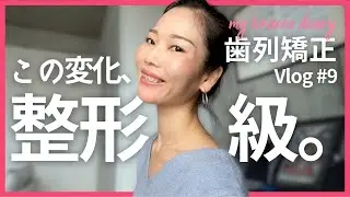 【歯列矯正】人中短くなった｜抜歯ワイヤー矯正の1年6カ月目｜ビフォーアフター写真公開