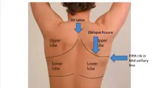 Surface marking of lung