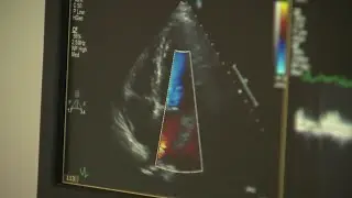 The importance of cardiac calcium screening