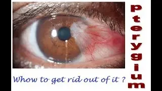 what is pterygium? How to get rid out of this? (Bengali)
