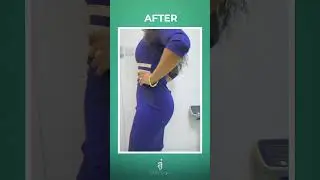 LIPO 360, BUTT LIFT & BREAST AUGMENTATION BEFORE & AFTER