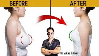 Breast Reduction Surgery: Pain, Recovery & Results | Dr. Vikas Gawri, Ludhiana