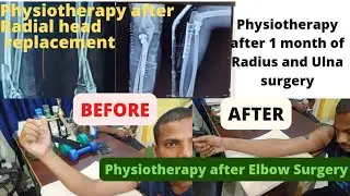 Physiotherapy after Elbow Surgery.Physiotherapy after Radial head replacement &Proximal ulna surgery