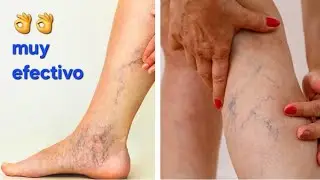 REMEDIO NATURAL PARA ELIMINAR LAS VARICES. 