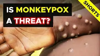 Doctor explains: Is MONKEYPOX a Threat? (June 2022 update)