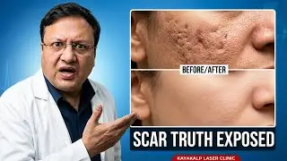 Acne Scar Removal Results | Best Combination Treatment Explained