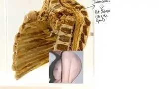Spine:  Pott's disease causing severe kyphosis