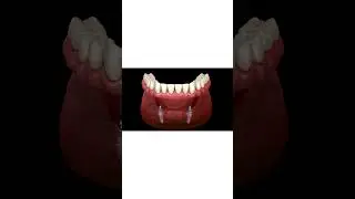 🦷🔩 Mandibular Denture on Implants &ndash; All-on-2 System | Dr. Khushboo Soni| Dentist| Your Grin, Our Win