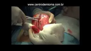 Mioma Uterino - Cirurgia de Miomectomia