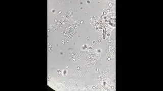 Trichomonas vaginalis in urine at 400x