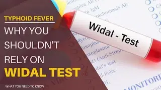 Typhoid Fever: Why You Shouldn't Rely On Widal Test - What You Need To Know