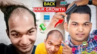 I Used MINOXIDIL for 30 Days and Here's What Happened