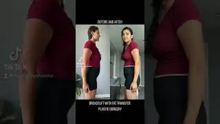 PLASTIC SURGERY Before and After Pictures - Breastlift with Fat Transfer