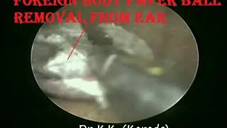 Foreign Body Paper Ball Removal From Ear of 3yr Old Small Girl