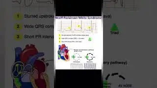 WPW Syndrome ECG Findings #ekg #cardiology