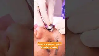 ✨Laser Toning for Under Eye Dark Circles: A Non-Invasive Solution @DermaVue #skincare ✨