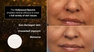 Tratament laser cu Holywood Spectra⚡Hollywood Peel⚡Rejuvenare facială cu efect imediat⚡Doctor SKiN💚