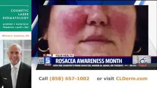 Rosacea Awareness | Expert San Diego Dermatologist Dr. Goldman