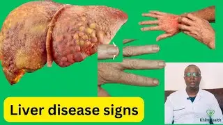 How Your Hands Are Exposing Liver Damage &mdash; Warning Signs You Must Not Ignore