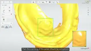 Impression Scanning Workflow (3Shape TRIOS)