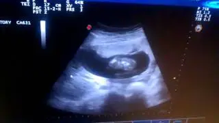 Brian bones appear!