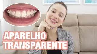 APARELHO ORTODONTICO TRANSPARENTE DE SAFIRA: Machuca? É caro? Amarela? Vale a pena?