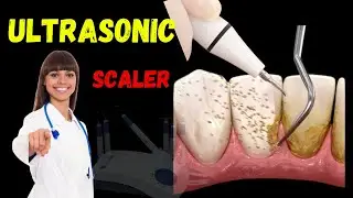 What is Ultrasonic Scaler | Ultrasonic Scalers: Function and Benefits