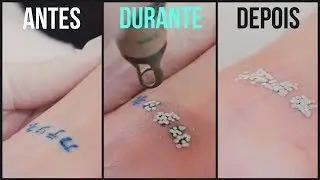 REMOÇÃO DE TATUAGEM - LASER TATTOO REMOVAL