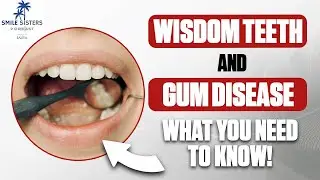 Wisdom Teeth and Gum Disease: What You Need to Know! - Smile Sisters Podcast