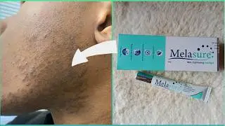 5 Best Pharmacy Creams for Men&rsquo;s Pigmentation 2025! #skincare #glowingskin #pigmentation #clearskin